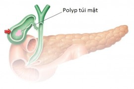 Bệnh Polyp túi mật những tư vấn từ Bác sĩ Bệnh viện Đa khoa Khách sạn Quốc tế VinMec