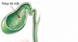 Ðiều trị polyp túi mật