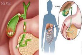 Người bị bệnh Sỏi mật, chữa thế nào?