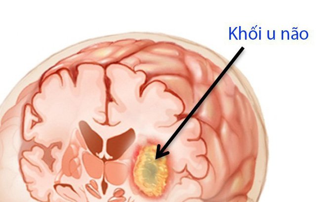 Bệnh ung thư não: 7 dấu hiệu cảnh báo u não