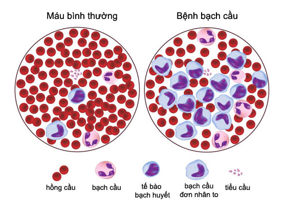 Tìm hiểu bệnh Ung thư Máu và biểu hiện khi bị bệnh