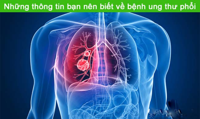 Cách phát hiện sớm các triệu chứng của bệnh ung thư phổi