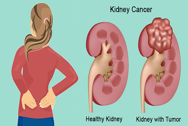 Những dấu hiệu nhận biết có thể bạn bị bệnh ung thư thận