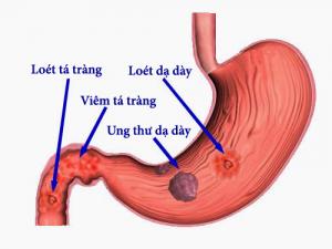 Triệu chứng và dấu hiệu bệnh ung thư dạ dày