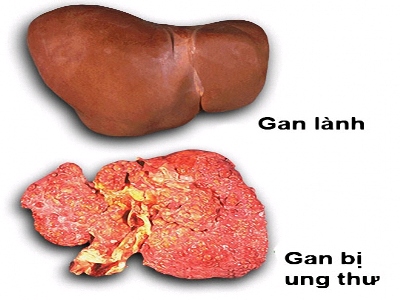 Tìm hiểu và nguyên nhân biểu hiện Ung thư gan