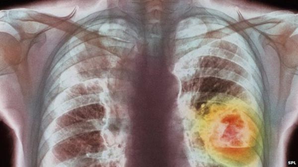 Ung thư phổi 7 dấu hiệu bạn cần biết