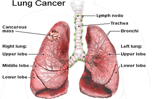 Những triệu chứng không thể bỏ qua của bệnh ung thư phổi