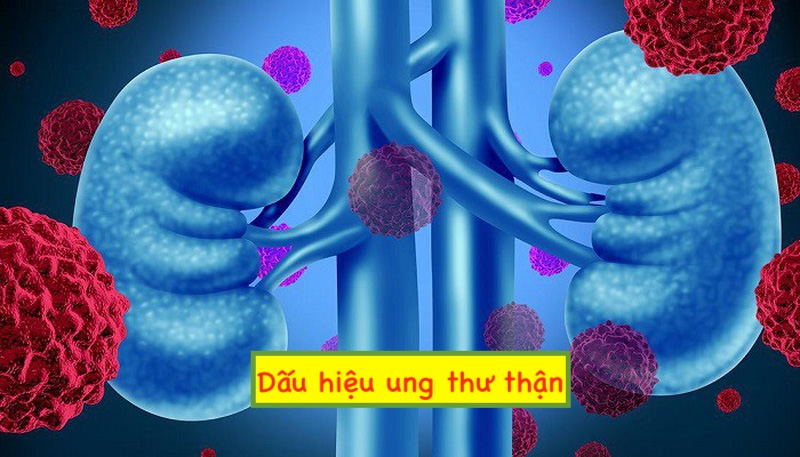 5 dấu hiệu nhận biết căn bệnh ung thư thận