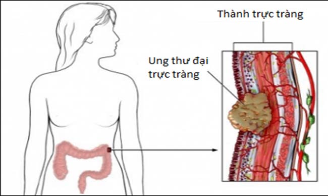 Dấu hiệu bạn đang mắc ung thư trực tràng