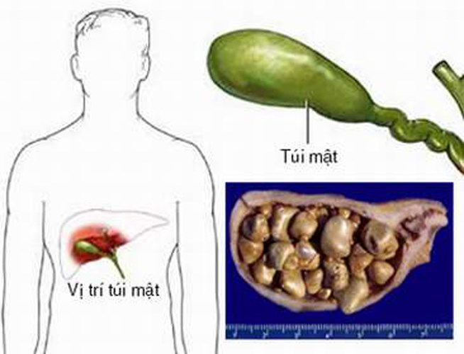 Dấu hiệu nhận biết ung thư túi mật