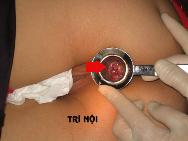 Bệnh trĩ