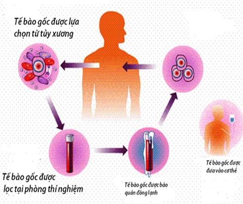 Những điều cần biết về ghép tế bào gốc điều trị ung thư máu