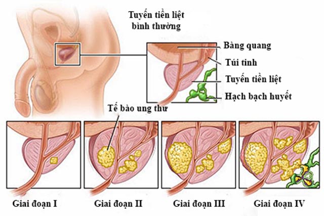 Ung thư tuyến tiền liệt hay còn gọi là ung thư tiền liệt tuyến là một dạng của ung thư phát triển trong tuyến tiền liệt, một tuyến trong hệ sinh dục nam. Ung thư tuyến tiền liệt phát triển chậm, tuy nhiên, có những trường hợp ung thư di căn.[1] Các tế bào ung thư có thể di căn (lan) từ tuyến tiền liệt sang các bộ phận khác của cơ thể, đặc biệt là vào xương và các hạch bạch huyết. Ung thư tuyến tiền liệt có thể gây đau đớn và khó khăn trong việc đi tiểu, quan hệ tình dục gặp vấn đề, hoặc rối loạn chức năng cương dương. Các triệu chứng khác có khả năng phát triển trong giai đoạn sau của bệnh.